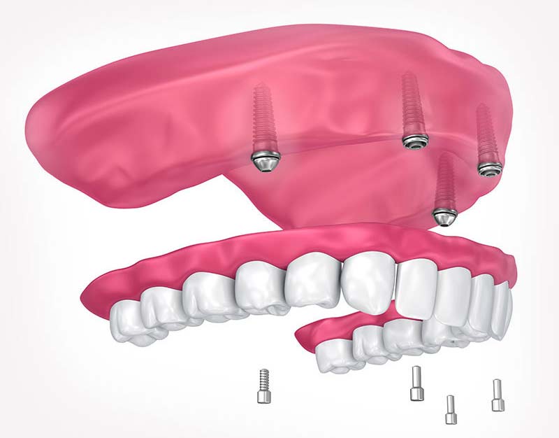 implant-supported-4-0n-4-dentures