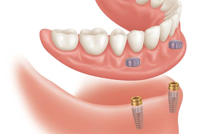 Snap-in-2-on-2 Denture