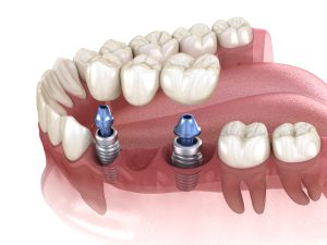 dental implant-supported dental bridge