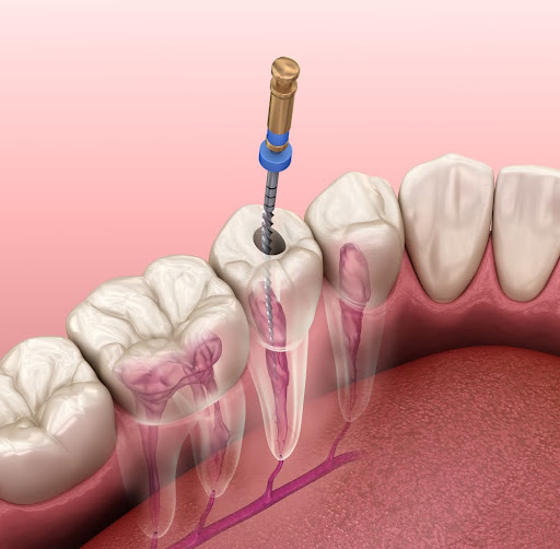 3d render of root canal therapy