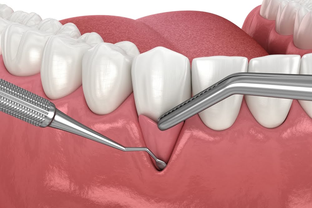 soft tissue or gum grafting can restore receding gums from periodontal disease