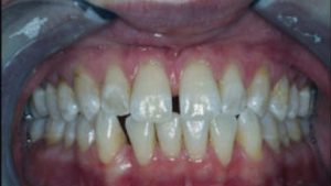 before smile treatment at Madison Dental Care
