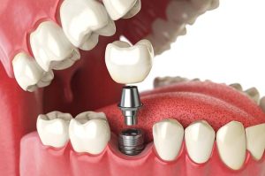 dental implants in Madison, AL