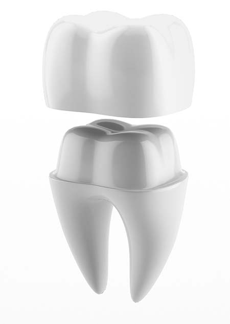 dental implant