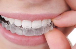 Invisalign in Madison, AL