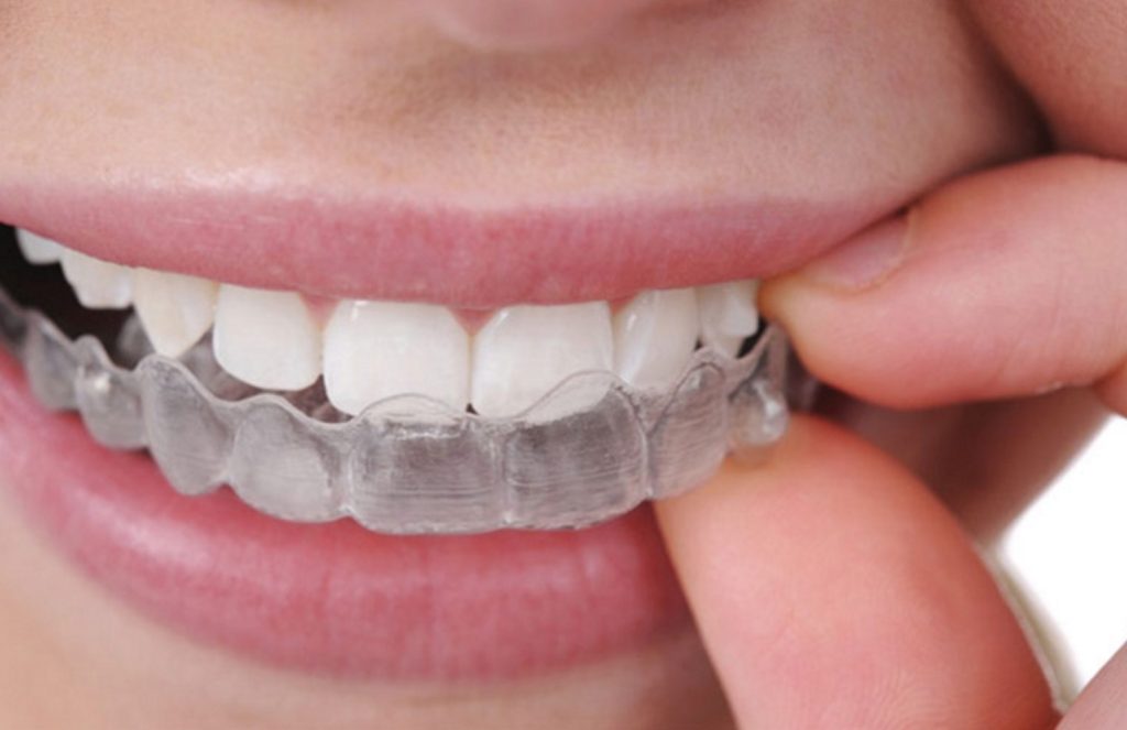 Invisalign at Madison Dental Care