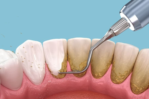 scaling and root planing treatment for gum disease