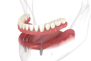 implant-supported denture
