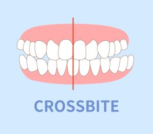 crossbite