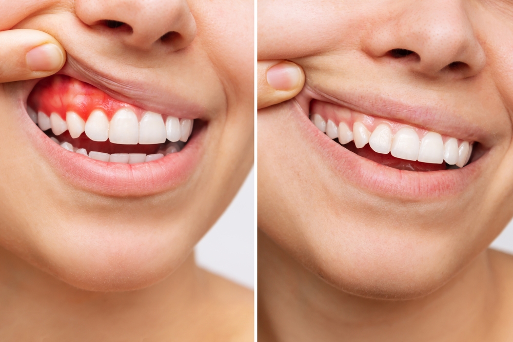 gum disease treatment