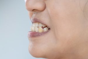 woman with underbite