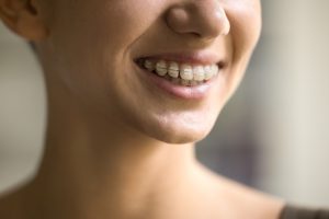 woman using braces to correct overbite