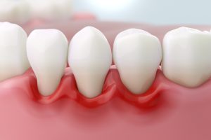 gum inflammation